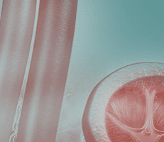 Kidney Transplant